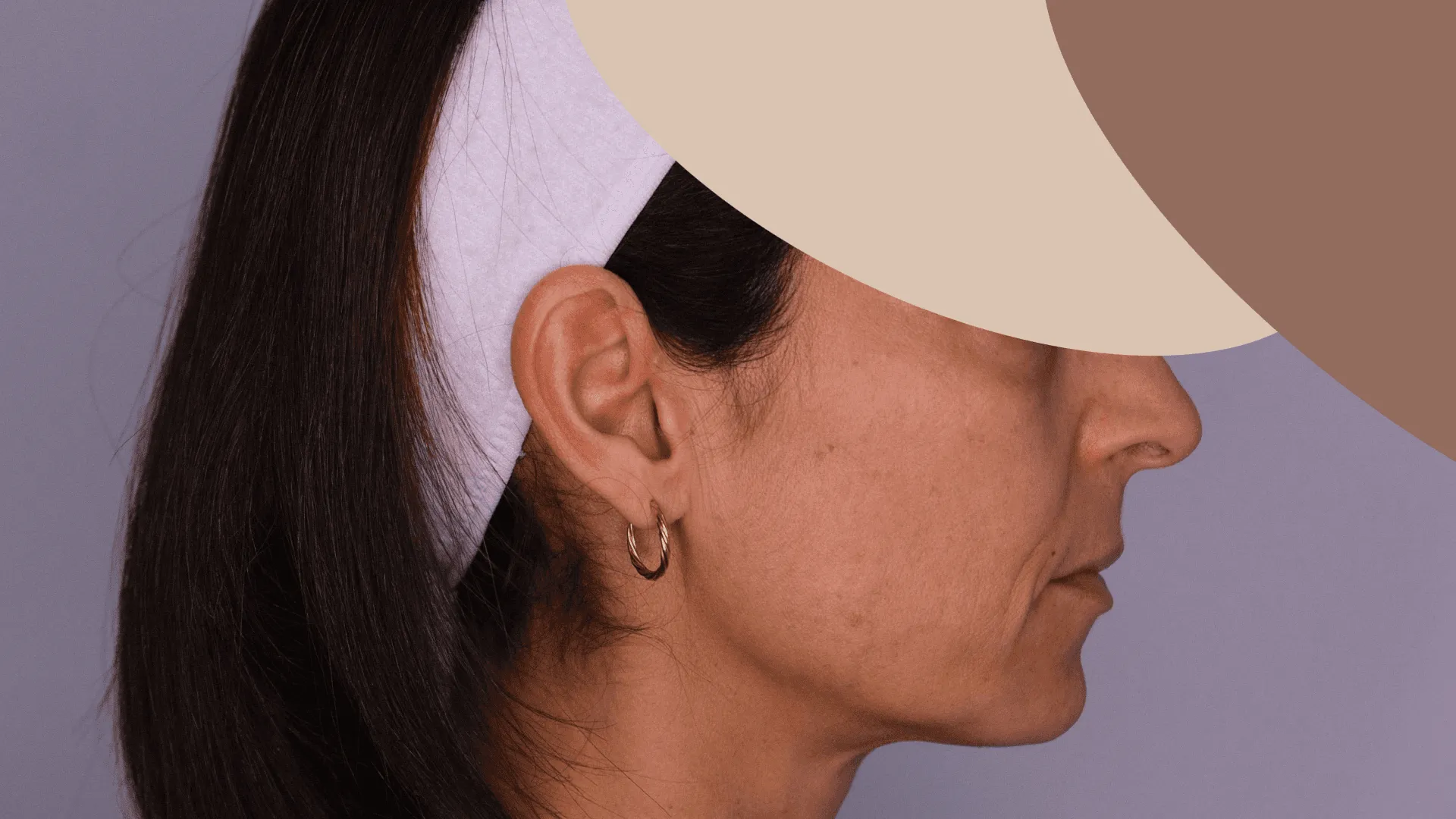 Resultado de peeling químico no rosto — antes
