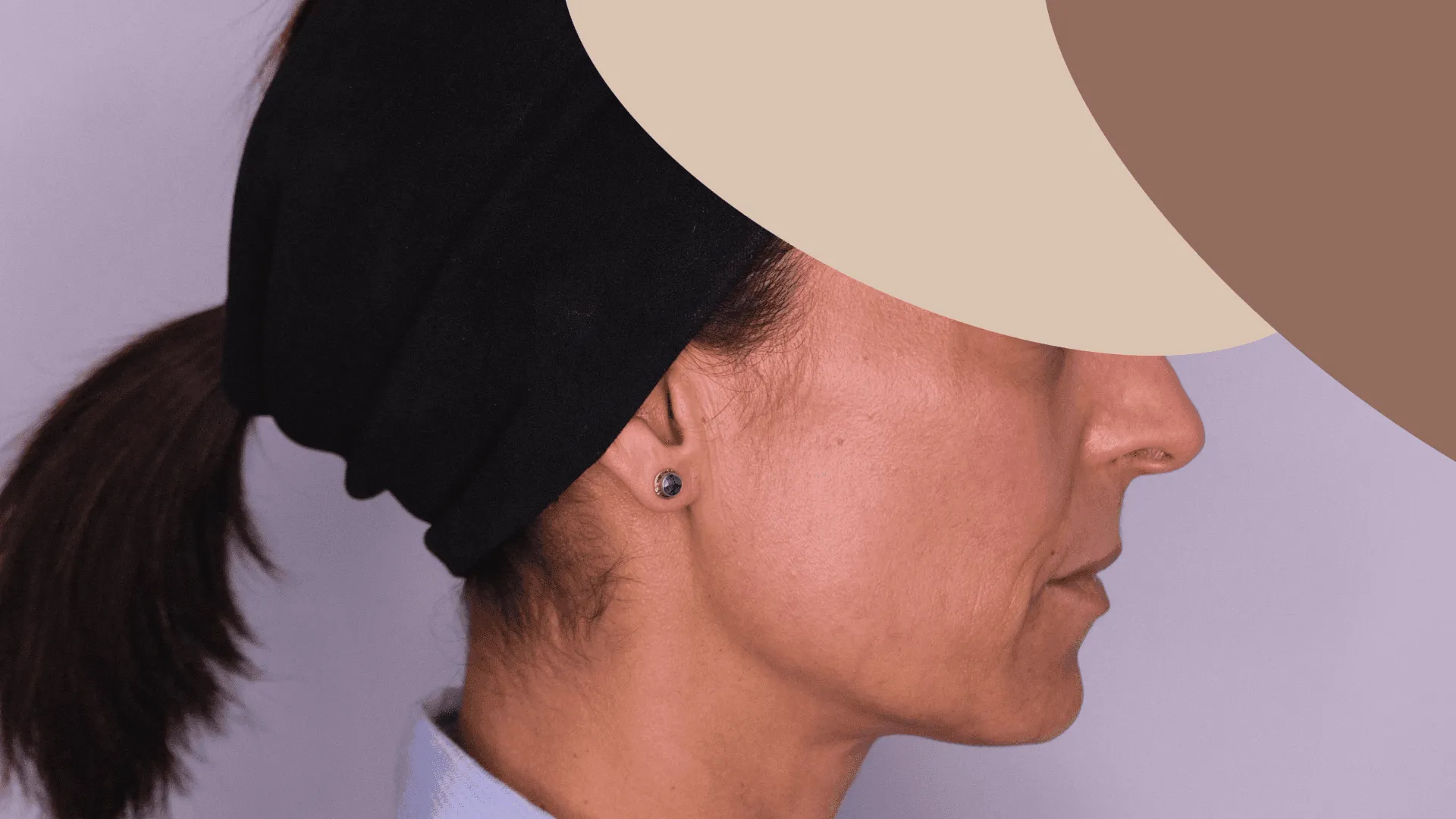 Resultado de peeling químico no rosto — depois