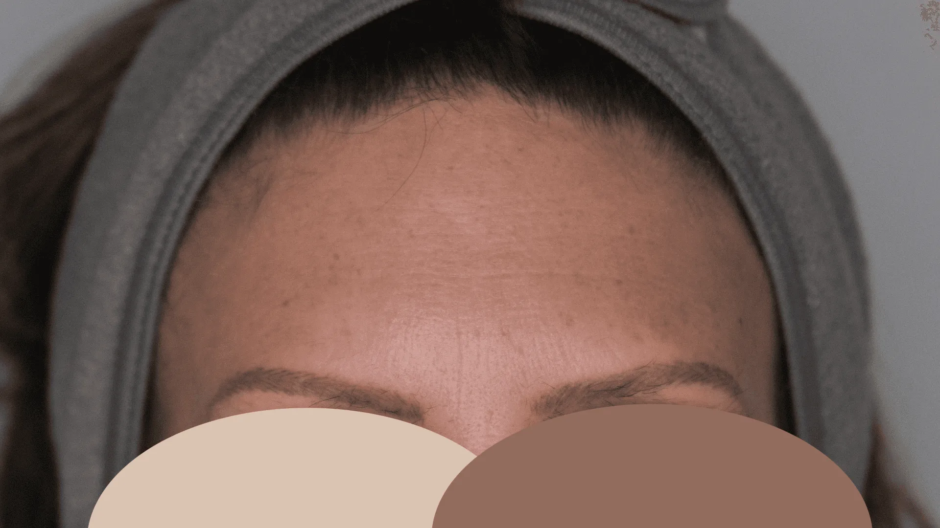Resultado de toxina botulínica na testa — depois